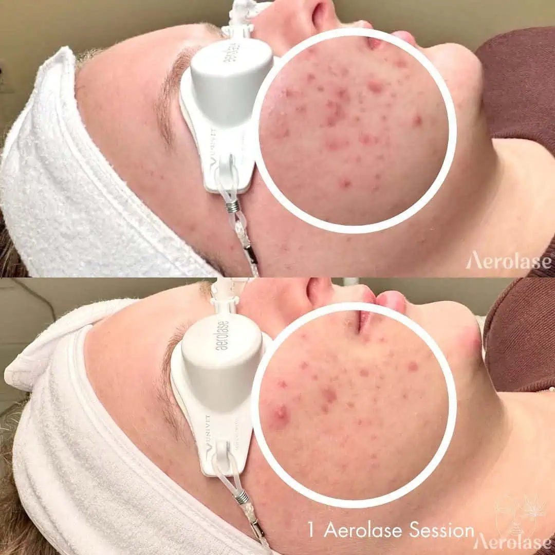 Acne - Photos courtesy of Bouq Skin (formerly The Hemp Spa)