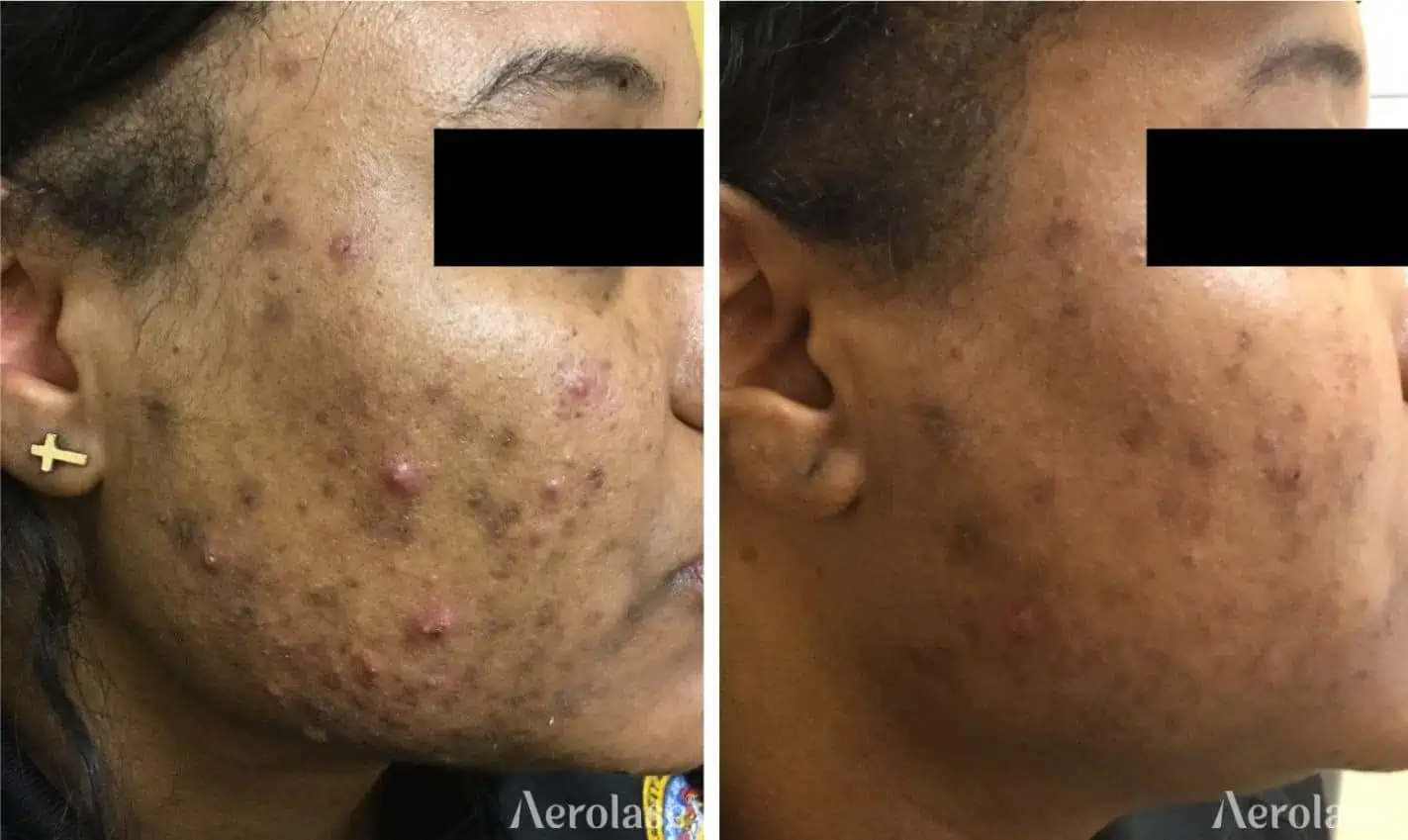 Acne - Photos courtesy of Chesahna Kindred, MD