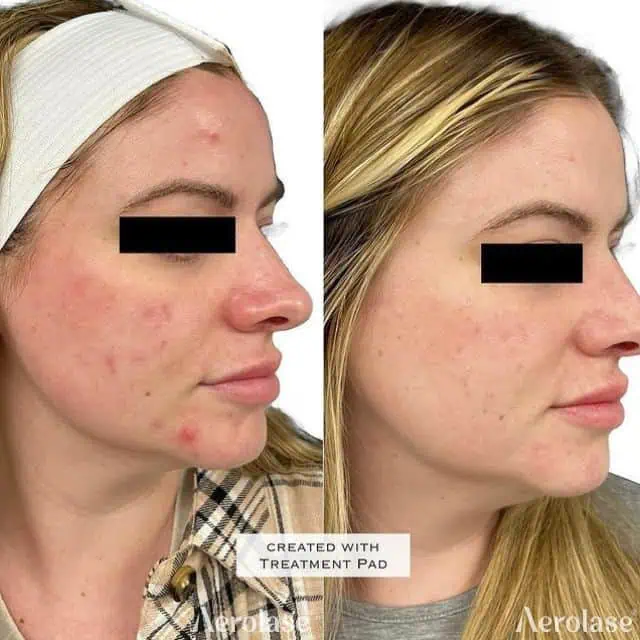 Acne - Photos courtesy of Aesthetic RN Jen