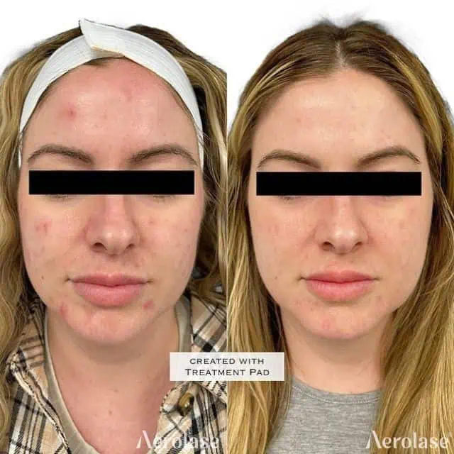 Acne - Photos courtesy of Aesthetic RN Jen