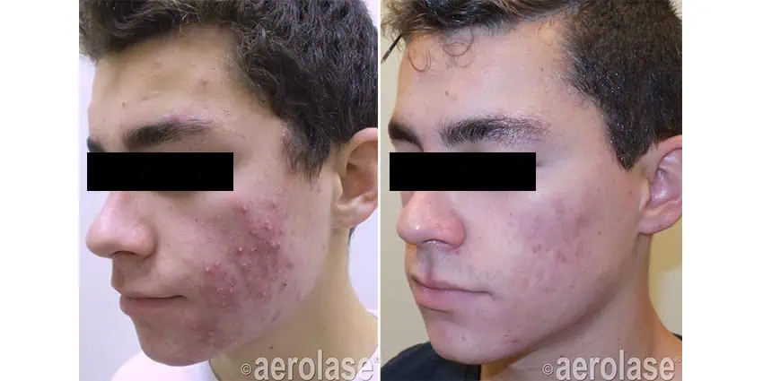 Acne - Photos courtesy of Kevin Pinski MD