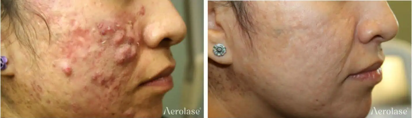 Acne - Photos courtesy of Michael Gold, MD