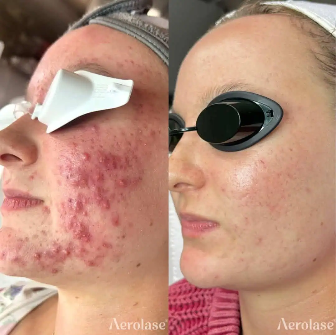 Acne - Photos courtesy of Sarah Ford