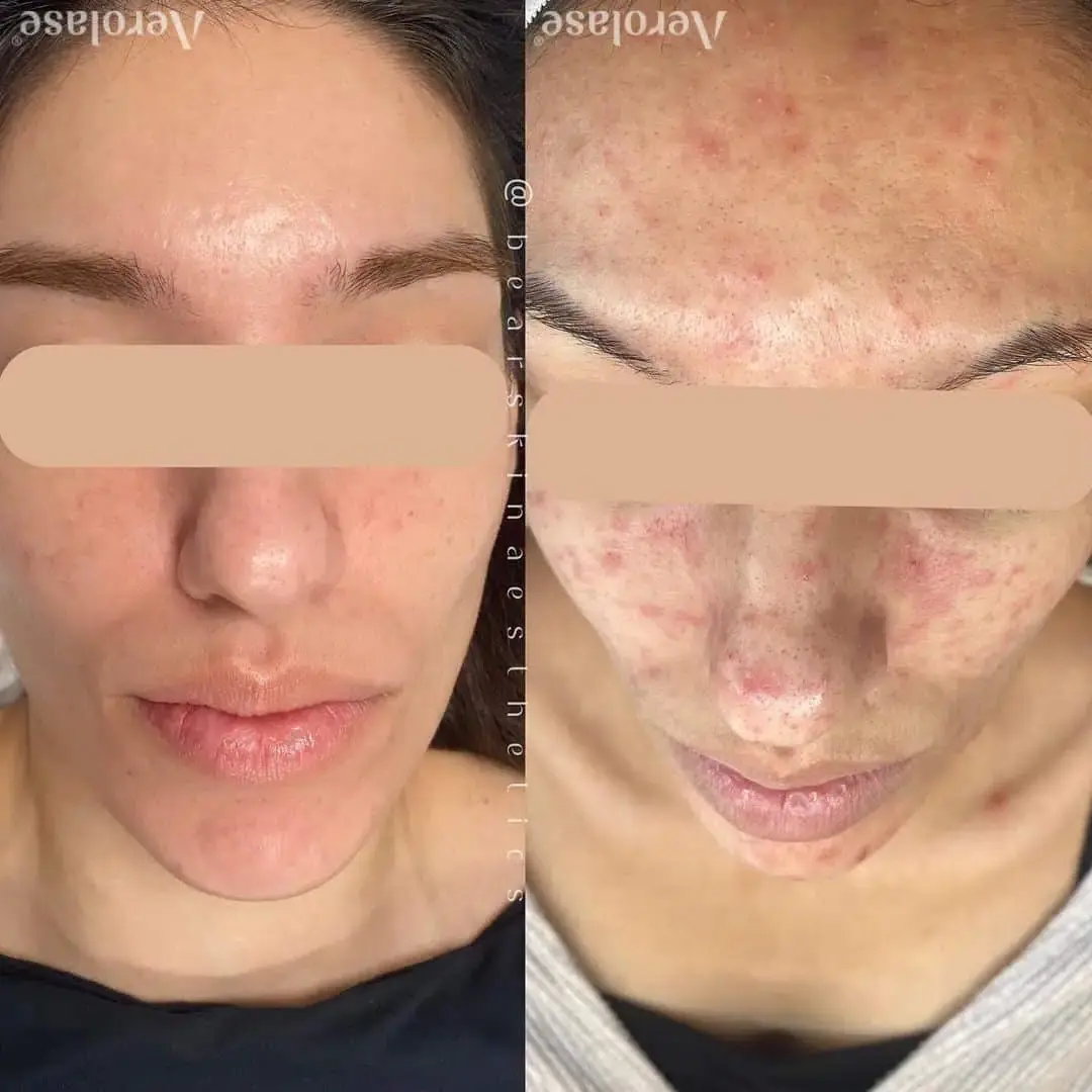 Acne - Photos courtesy of Bear Skin Aesthetics