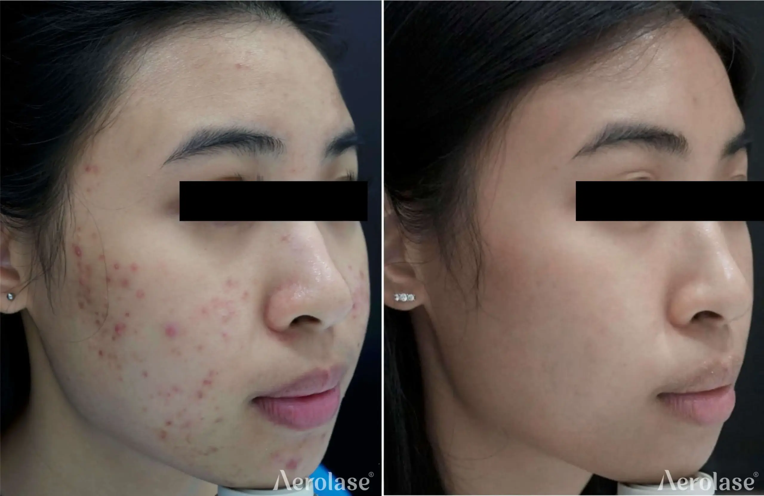 Acne -Photos courtesy of Dr. SK Tan
