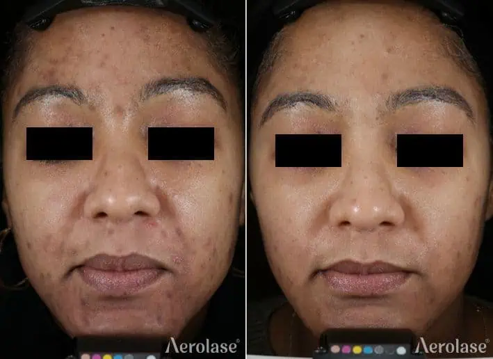 Acne - Photos courtesy of Goldberg - SOC