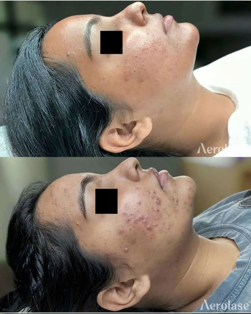 Acne - Photos courtesy of Kainat Paracha, MD