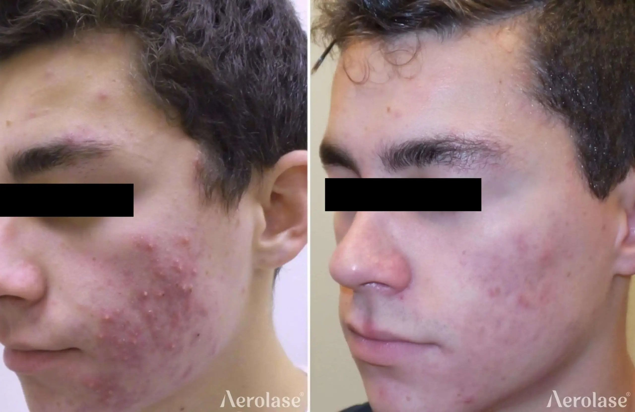 Acne - Photos courtesy of Kevin Pinski, MD