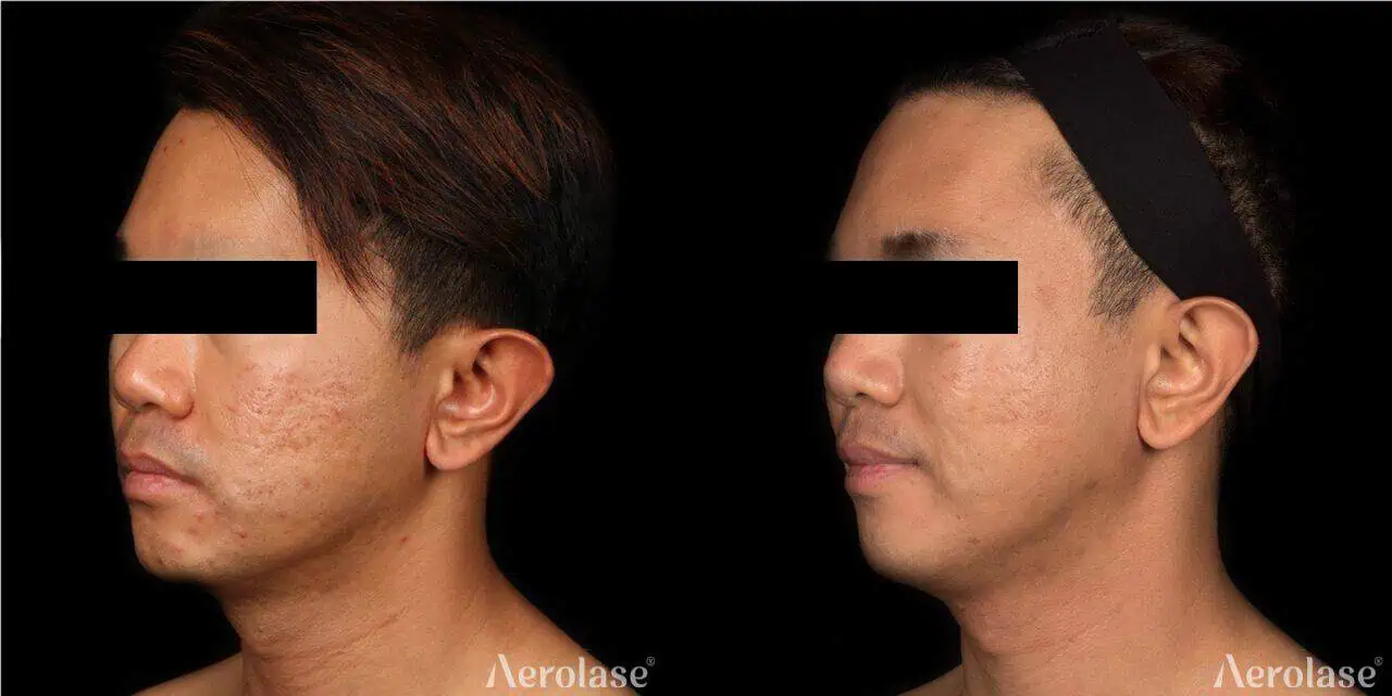 Acne Scars (Face) - Photos courtesy of Jason Emer, MD