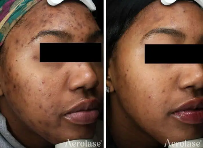 Acne and PIH - Photos courtesy of Nazanin Saedi, MD