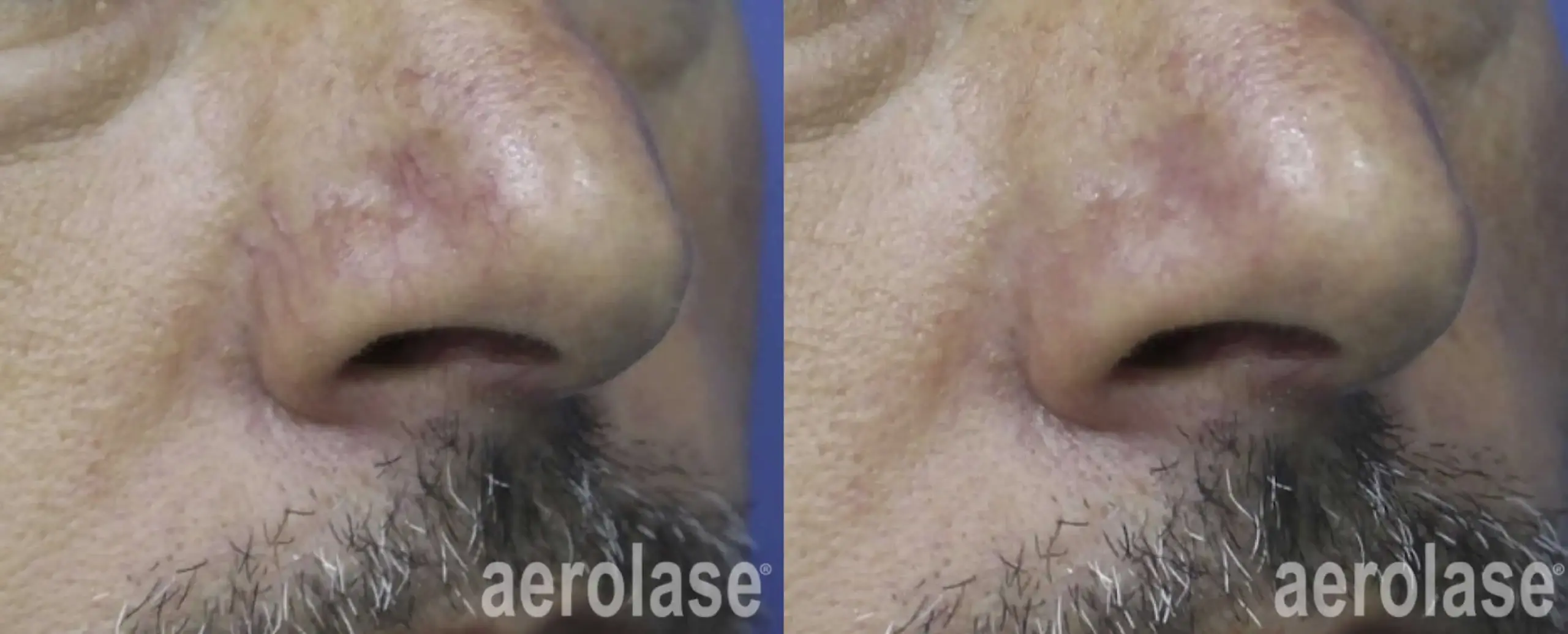 Facial Veins - Photos courtesy of Dr. Nabil Fakih