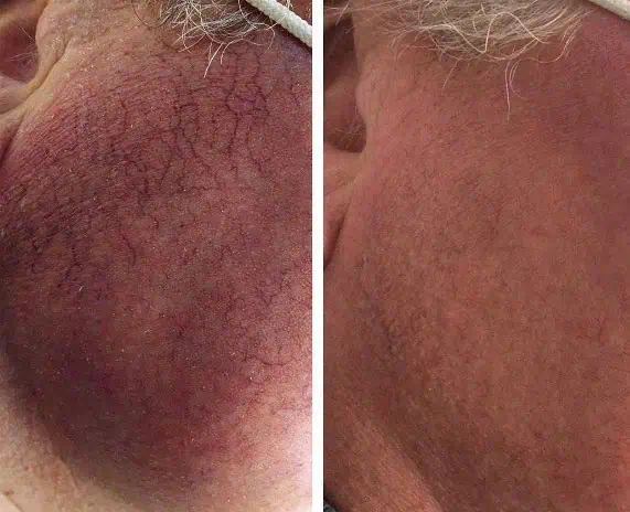 Facial Veins - Photos courtesy of Maine Laser Clinic Amato Poiselli MD