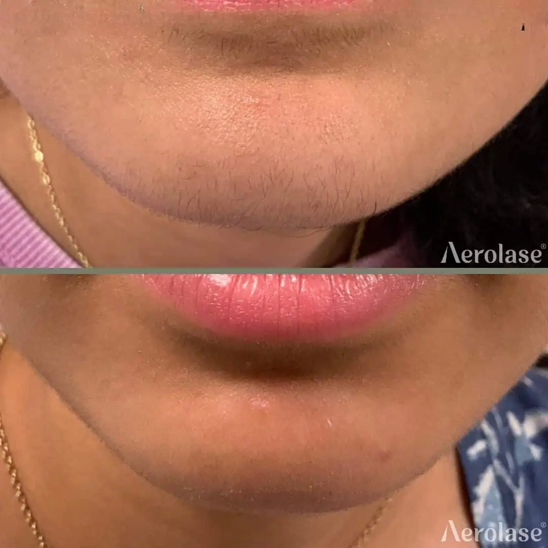 Hair Removal - Photos courtesy of Nicole Osterling