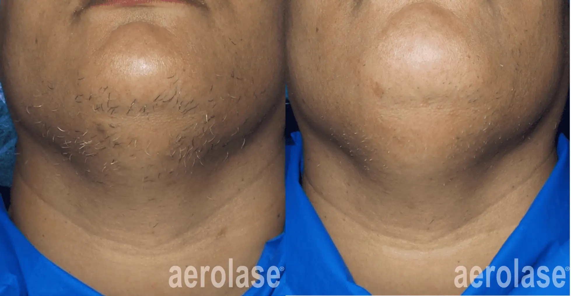 Hair Removal - Photos courtesy of Wendy Roberts, MD