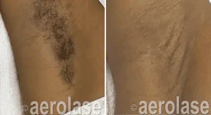 Hair Removal