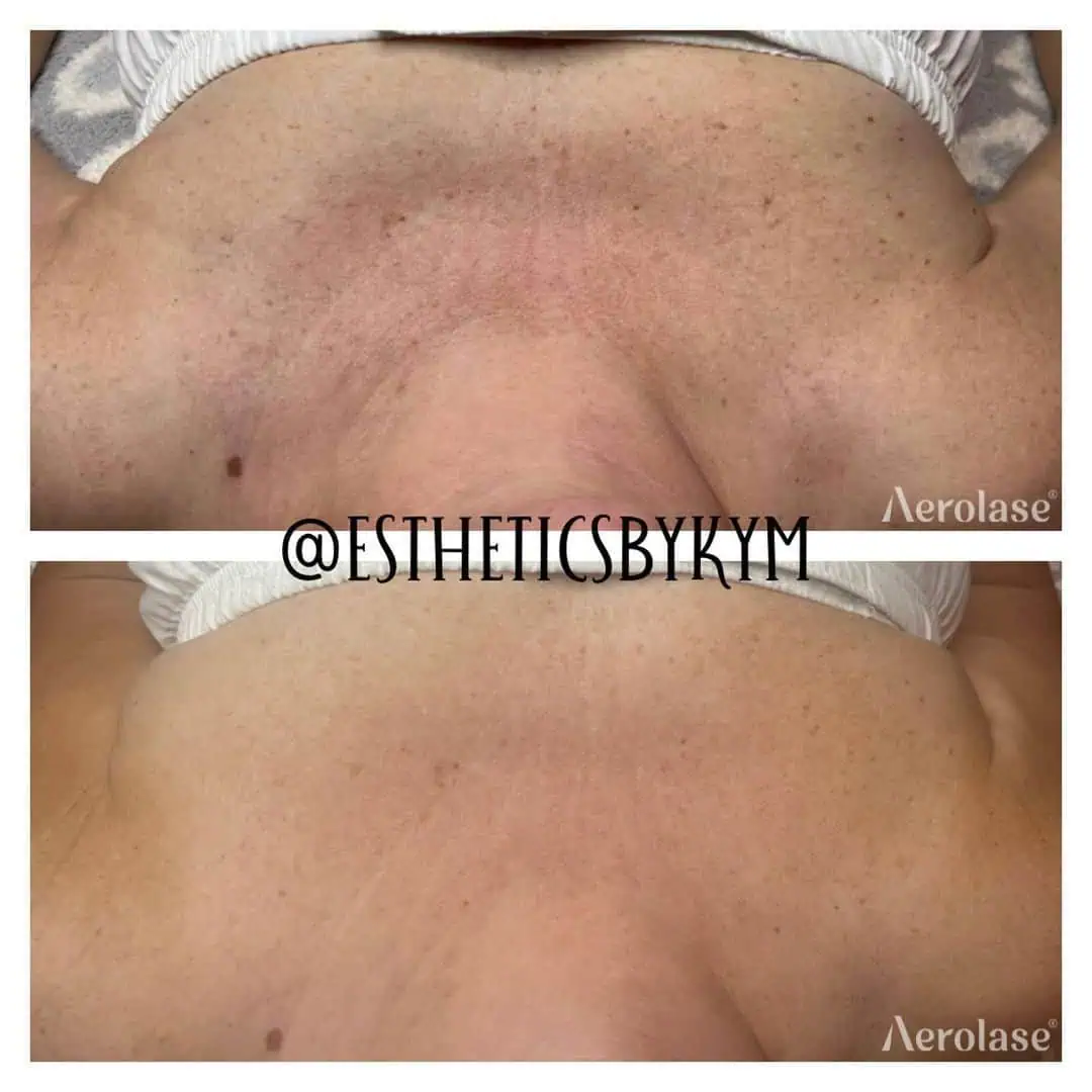 Hyperpigmentation - Photos courtesy of Esthetics By Kym