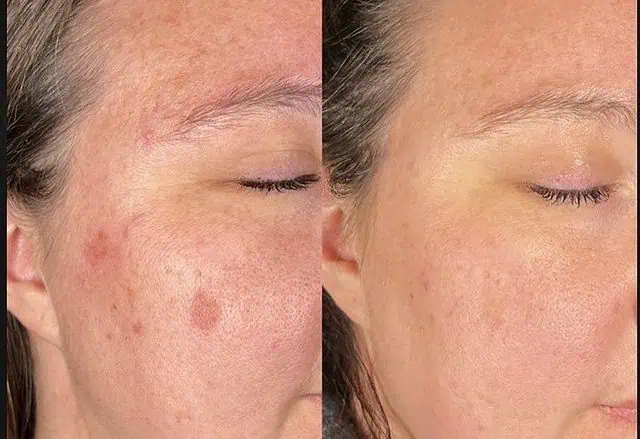 Hyperpigmentation