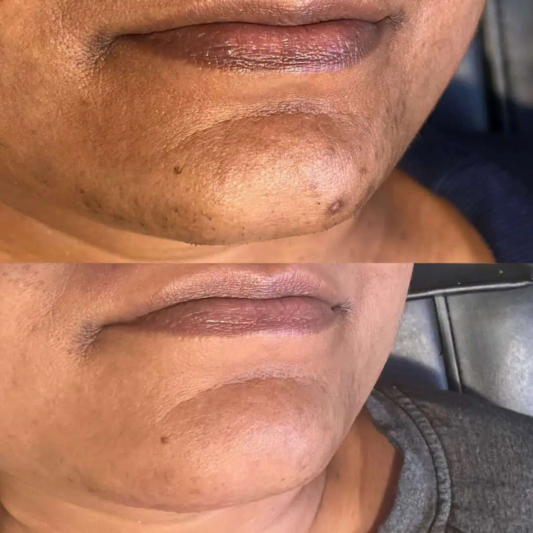 Hyperpigmentation - La Mone Aesthetics