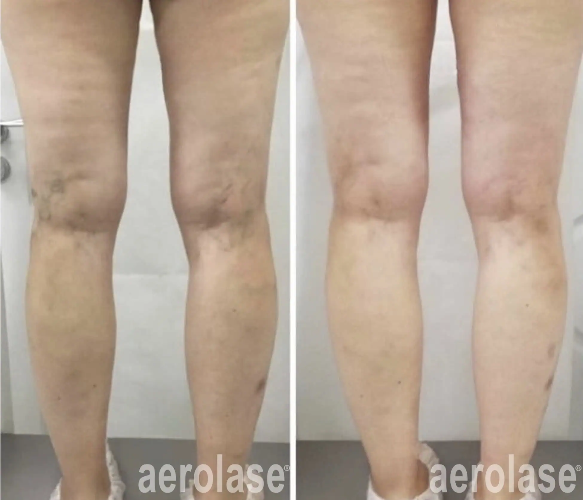 Leg Veins - Photos courtesy of Dr. Dmitrii Rosykhovskii, MD