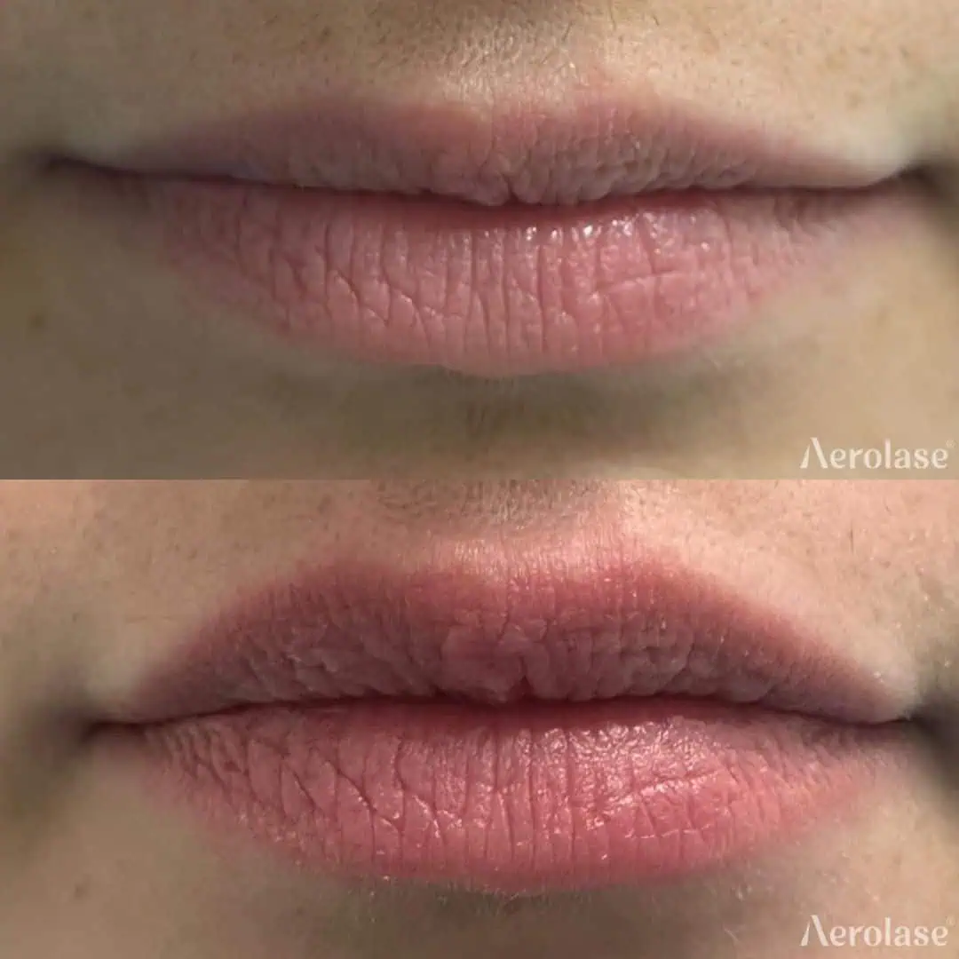Lip Rejuvenation