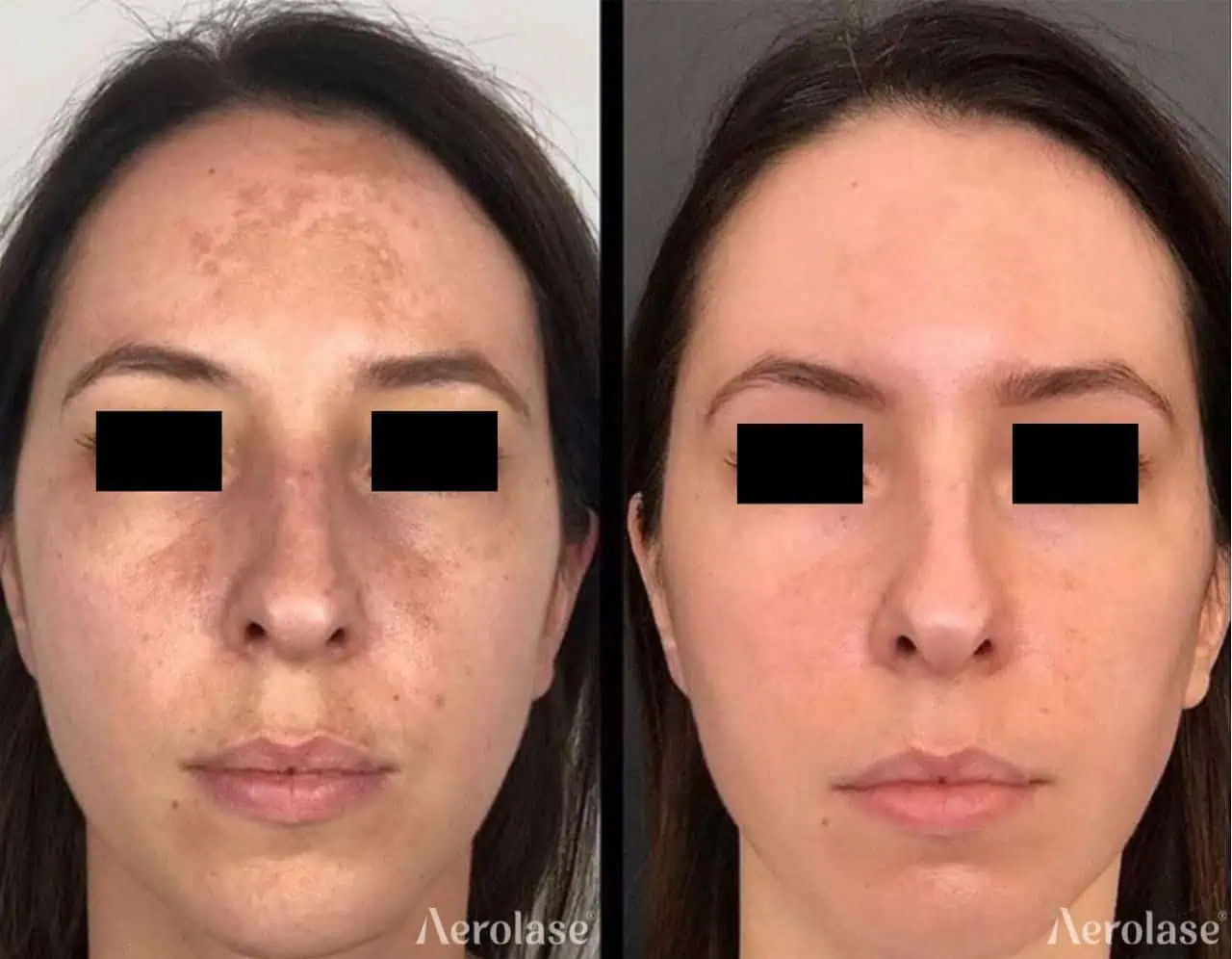 Melasma (Face) - Photos courtesy of Avanti Aesthetic Academy