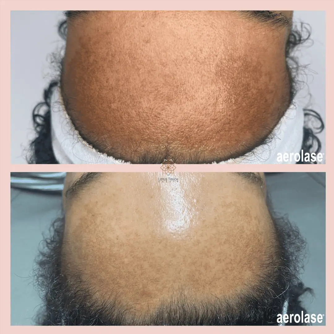 Melasma - Photos courtesy of Lotus Touch Beauty