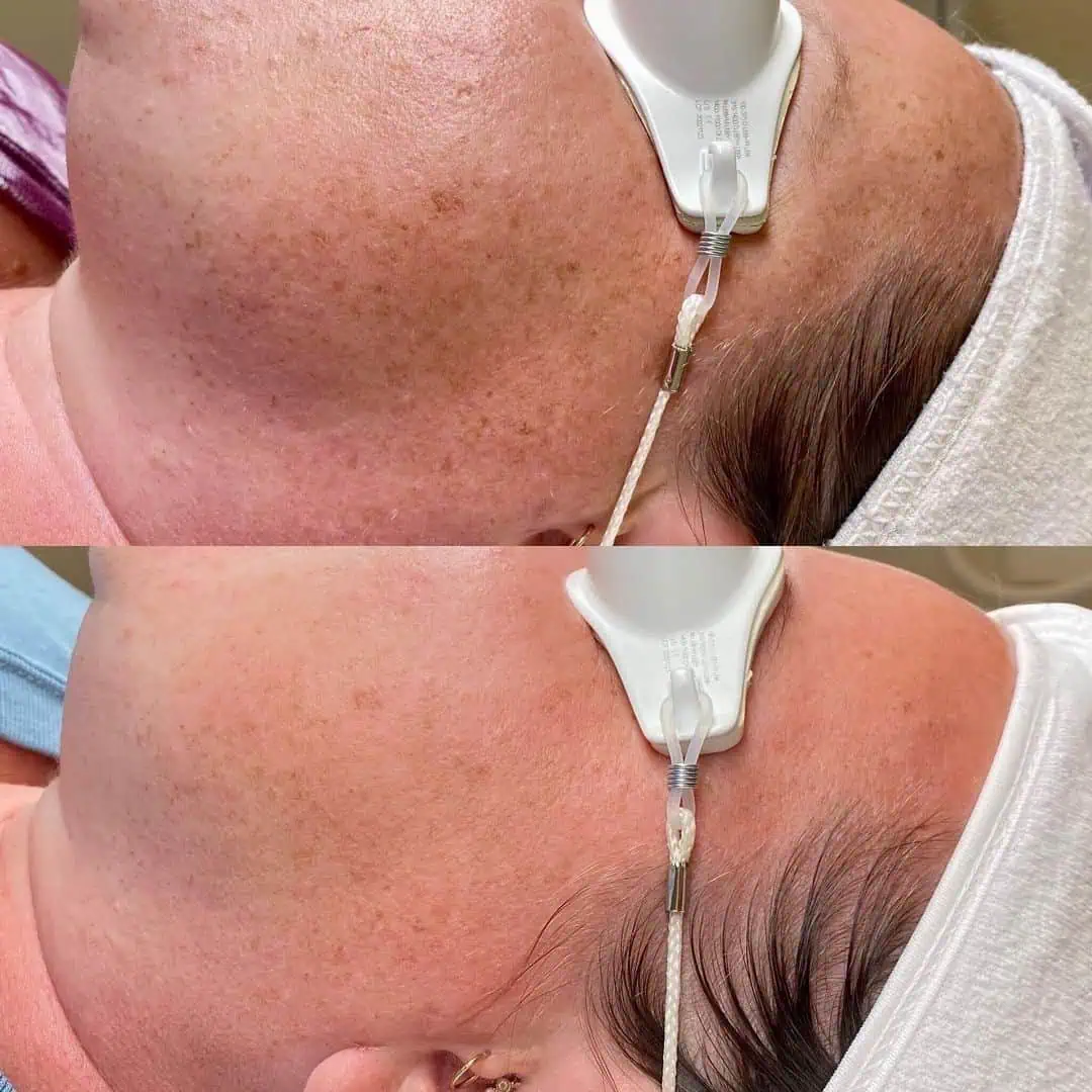 Melasma - Photo Courtesy of Kristyn The Esti