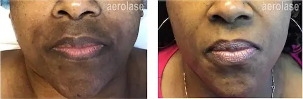 Melasma - Photos courtesy of Tiffany Crews