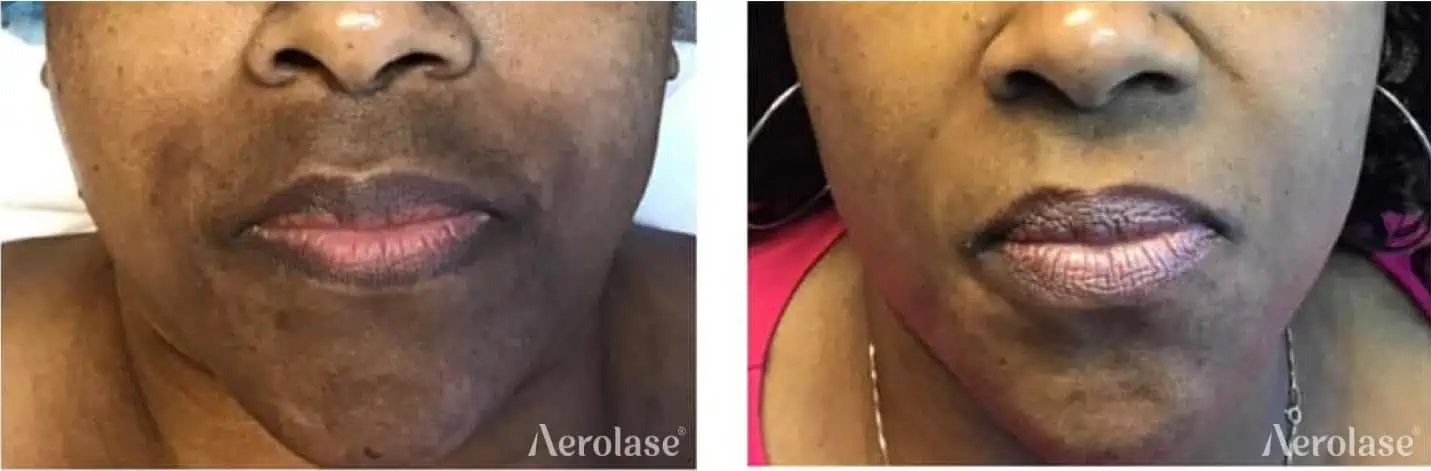 Melasma - Photos courtesy of Tiffany Crews