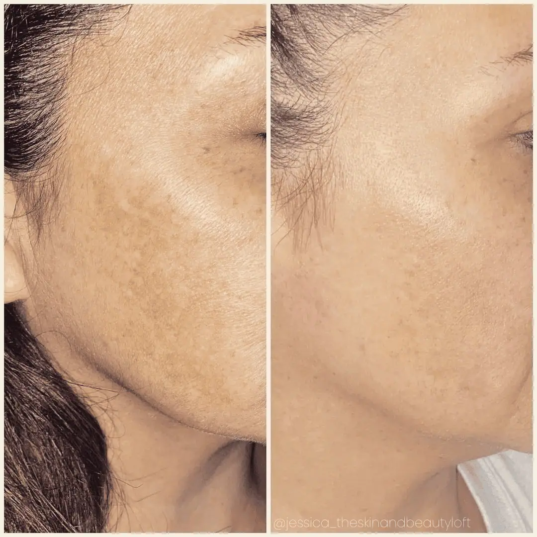 Melasma - Photos courtesy of The Skin & Beauty Loft