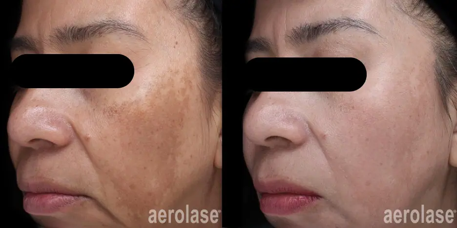 Melasma - Photos courtesy of jason emer, MD