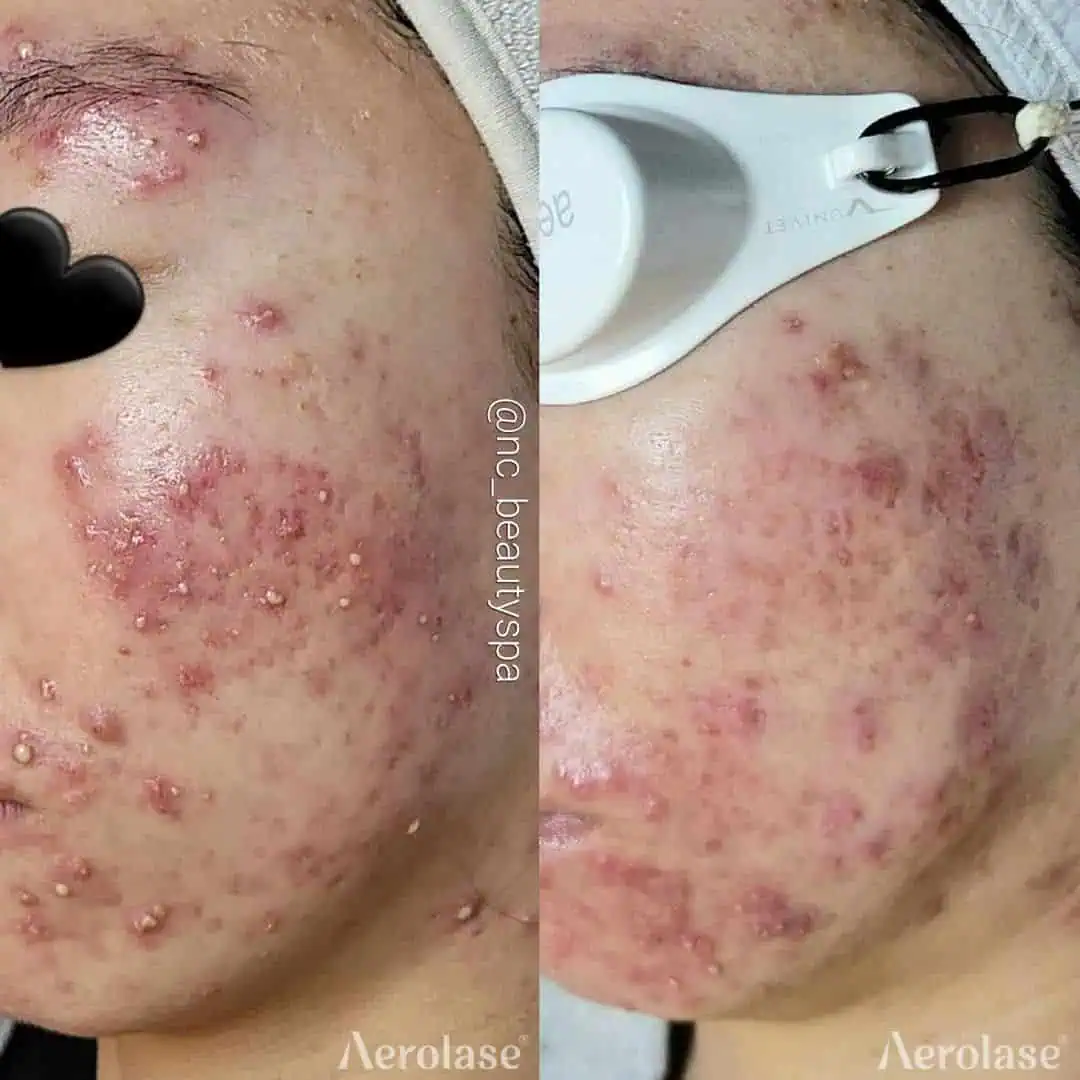Acne Photos courtesy of NCBeauty Spa