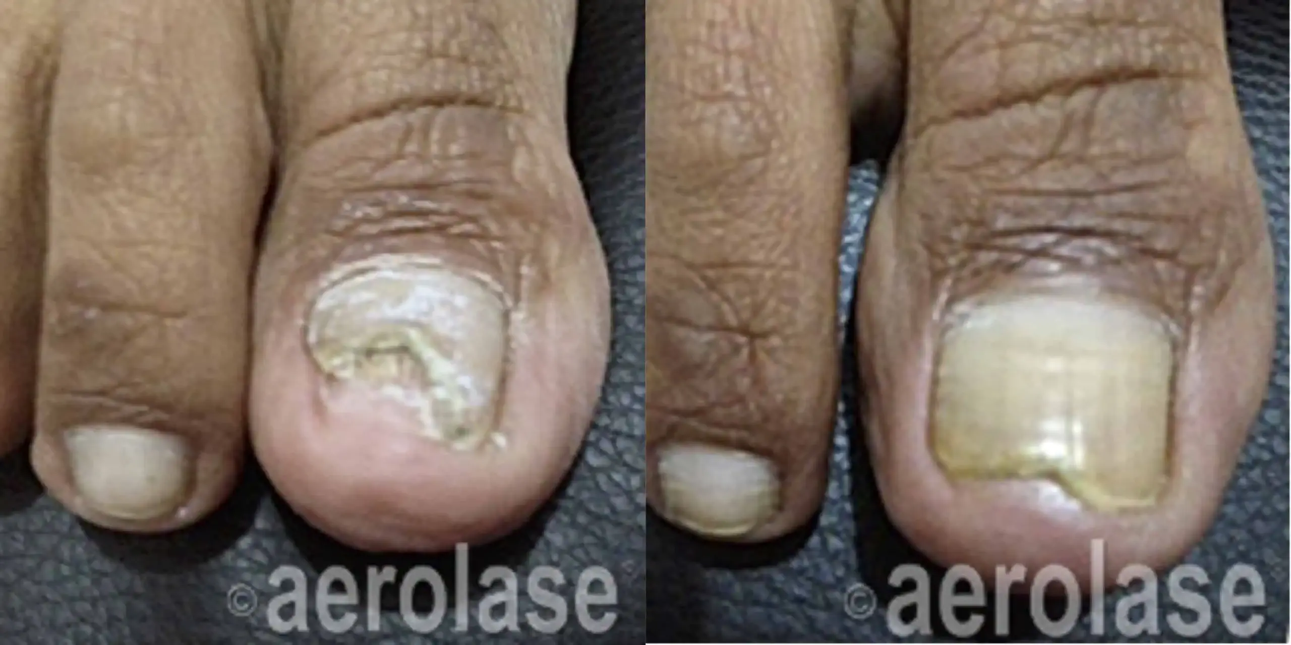 Nails - Photos courtesy of Dr. Raj Kumar