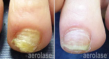 Nails - Photos courtesy of Lisa Hochman, MD