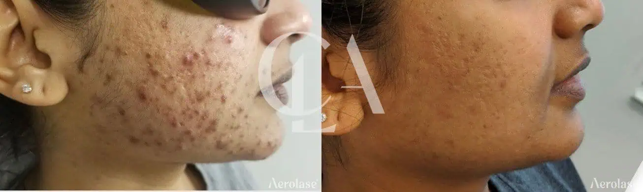 Acne - Photos courtesy of Nina Harry