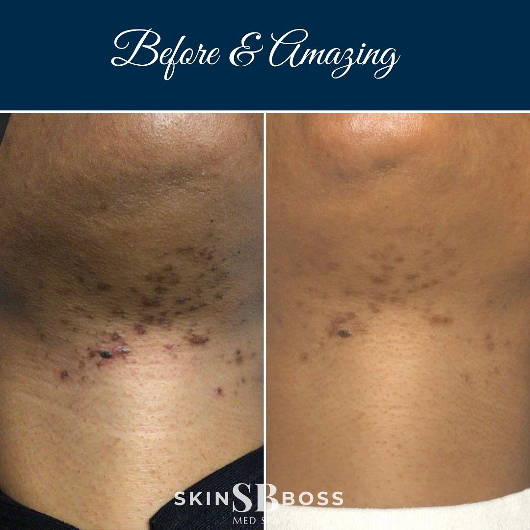 PFB (SOC) - Photos courtesy of Skin Boss Medspa