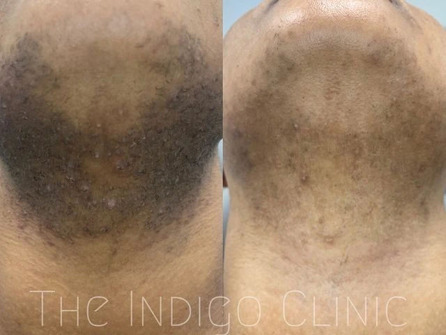 PFB - Photos courtesy of The Indigo Clinic