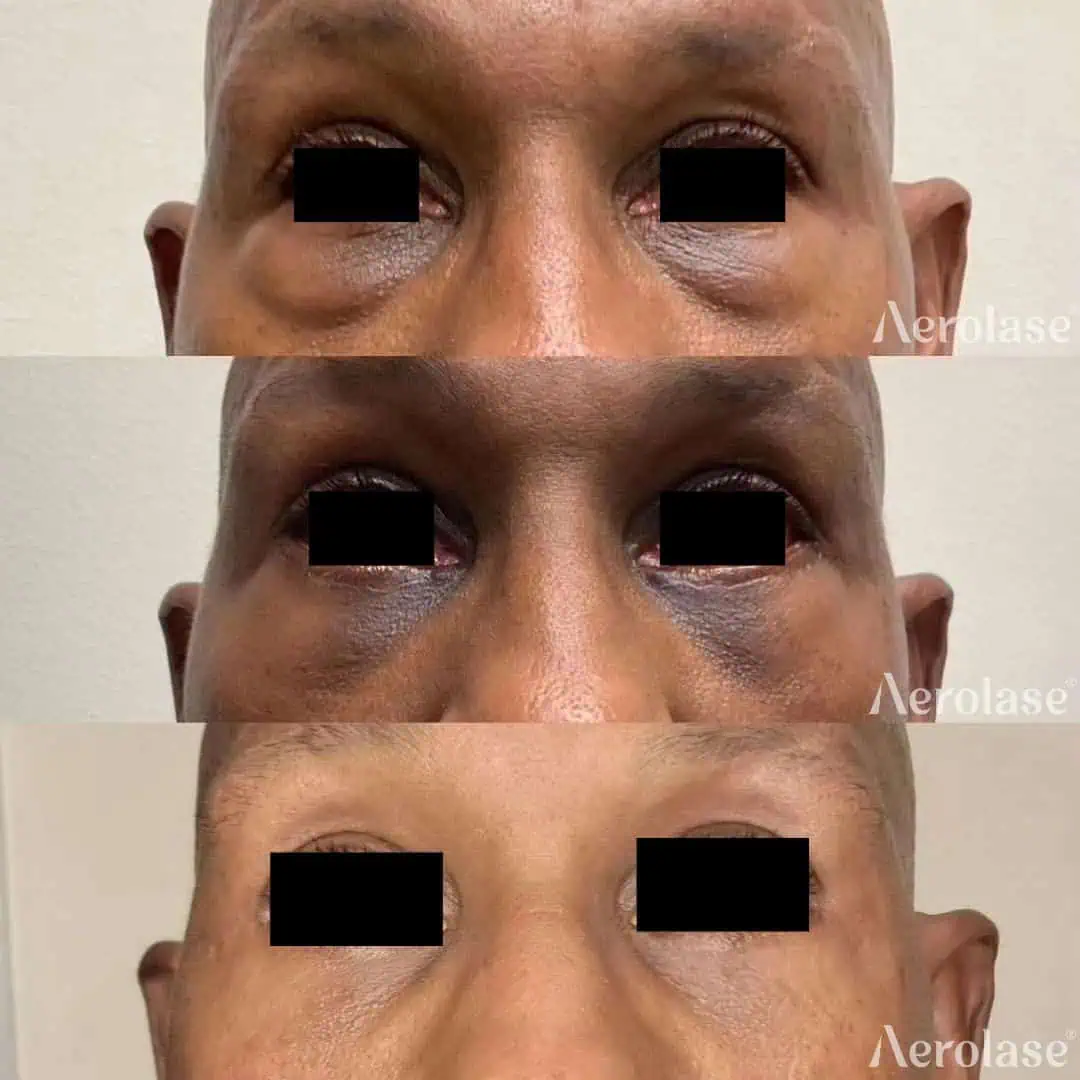 Pigmentation and Rejuvenation Post Lower Eyelid Surgery - Photos courtesy of Camille Cash MD