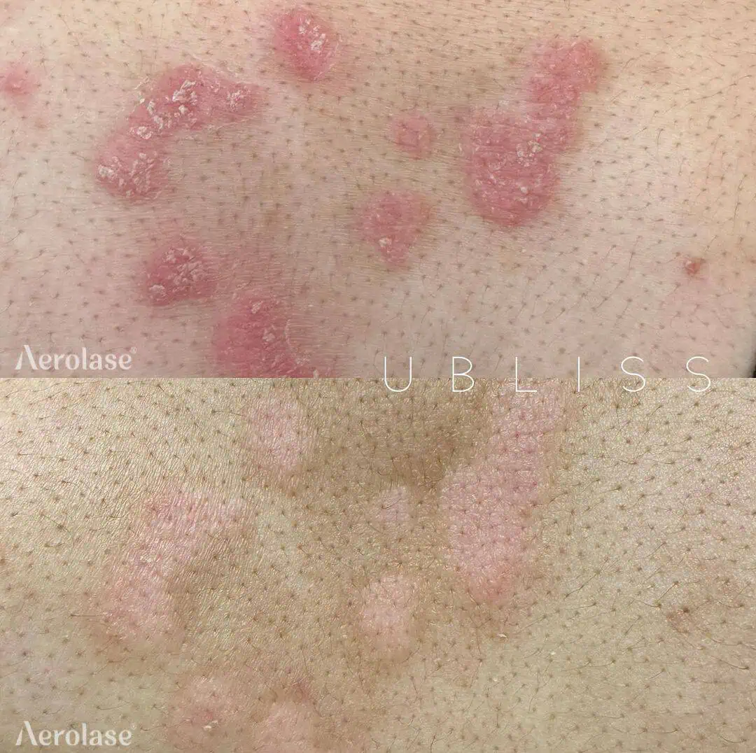 Psoriasis - Photos courtesy of Ubliss NY