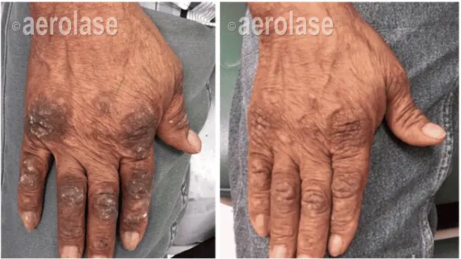 Psoriasis - Photos courtesy of Mark Nestor, MD, PhD