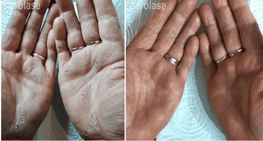 Psoriasis