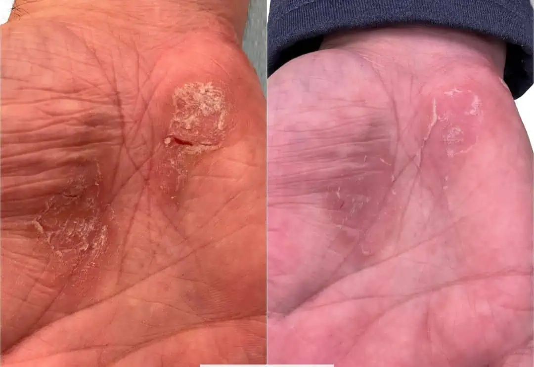 Psoriasis