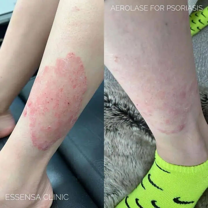 Psoriasis - Photos courtesy of Essensa Clinic
