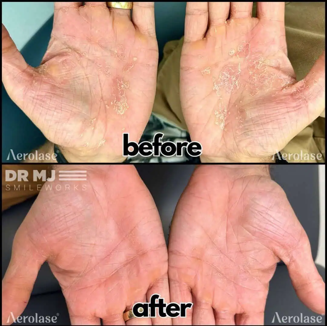 Psoriasis (Hands) - Photos courtesy of DR MJ Smile Works
