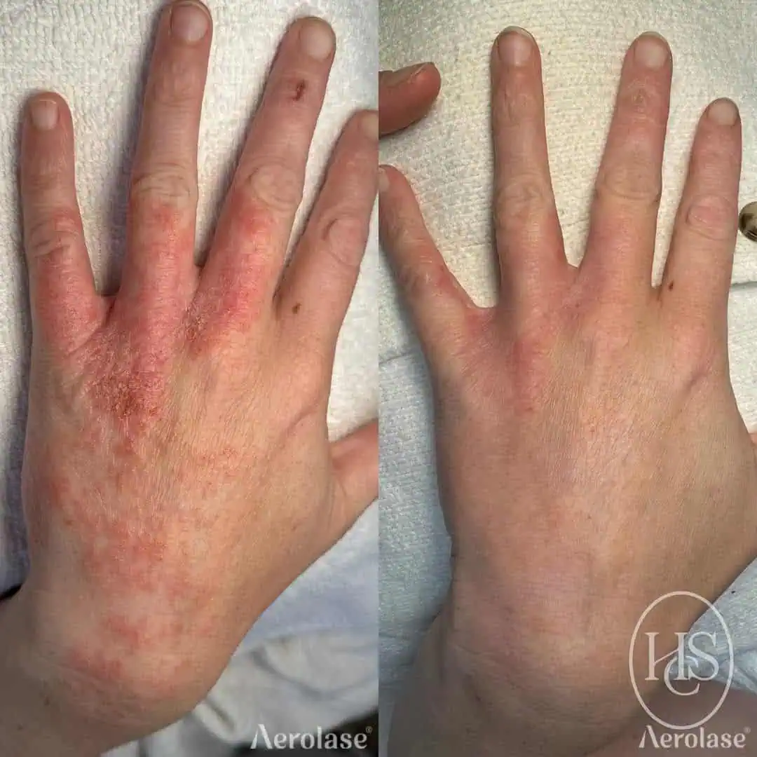 Psoriasis (Hands) - Photos courtesy of Holistic Skin Co