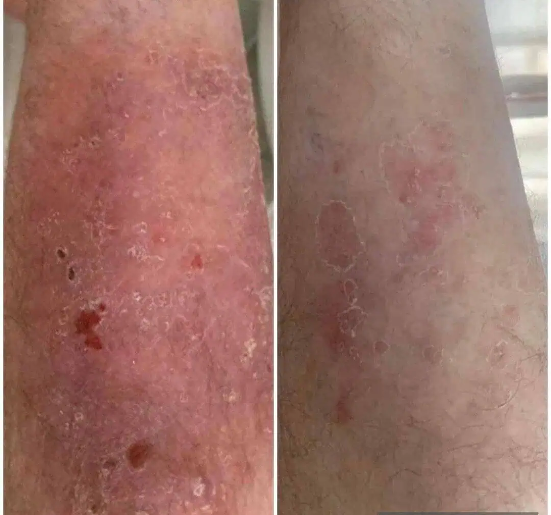 Psoriasis - Photos courtesy of Sante Second Regard
