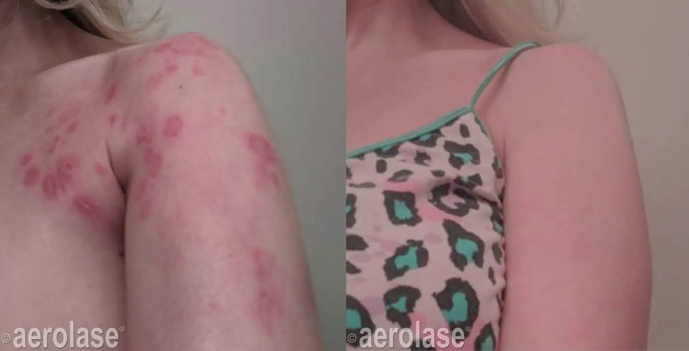 Psoriasis