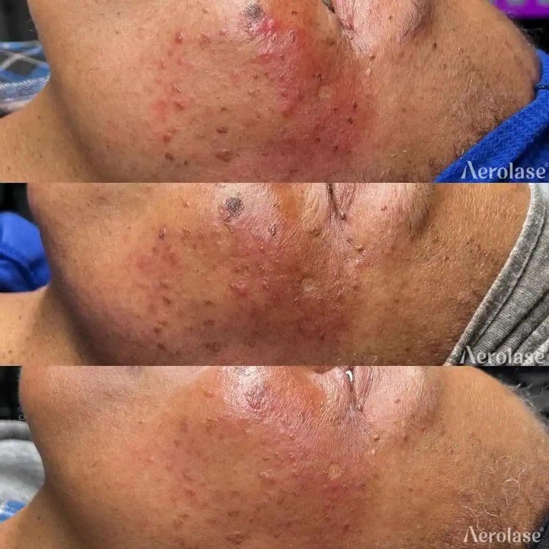 Redness, Acne, and Skin Tags - Photos courtesy of Kim Kreations Co