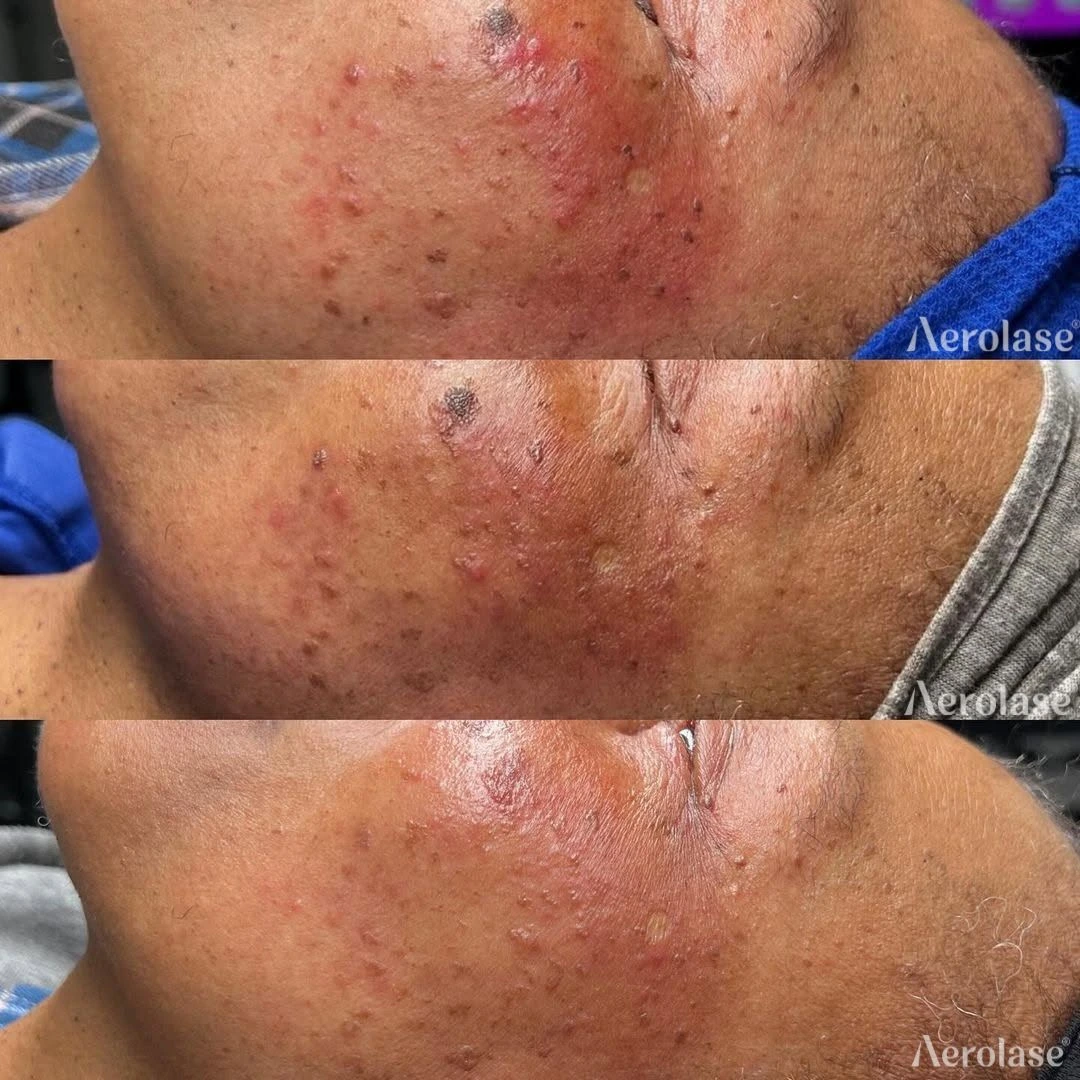 Redness, Acne, and Skin Tags Photos courtesy of Kim Kreations Co