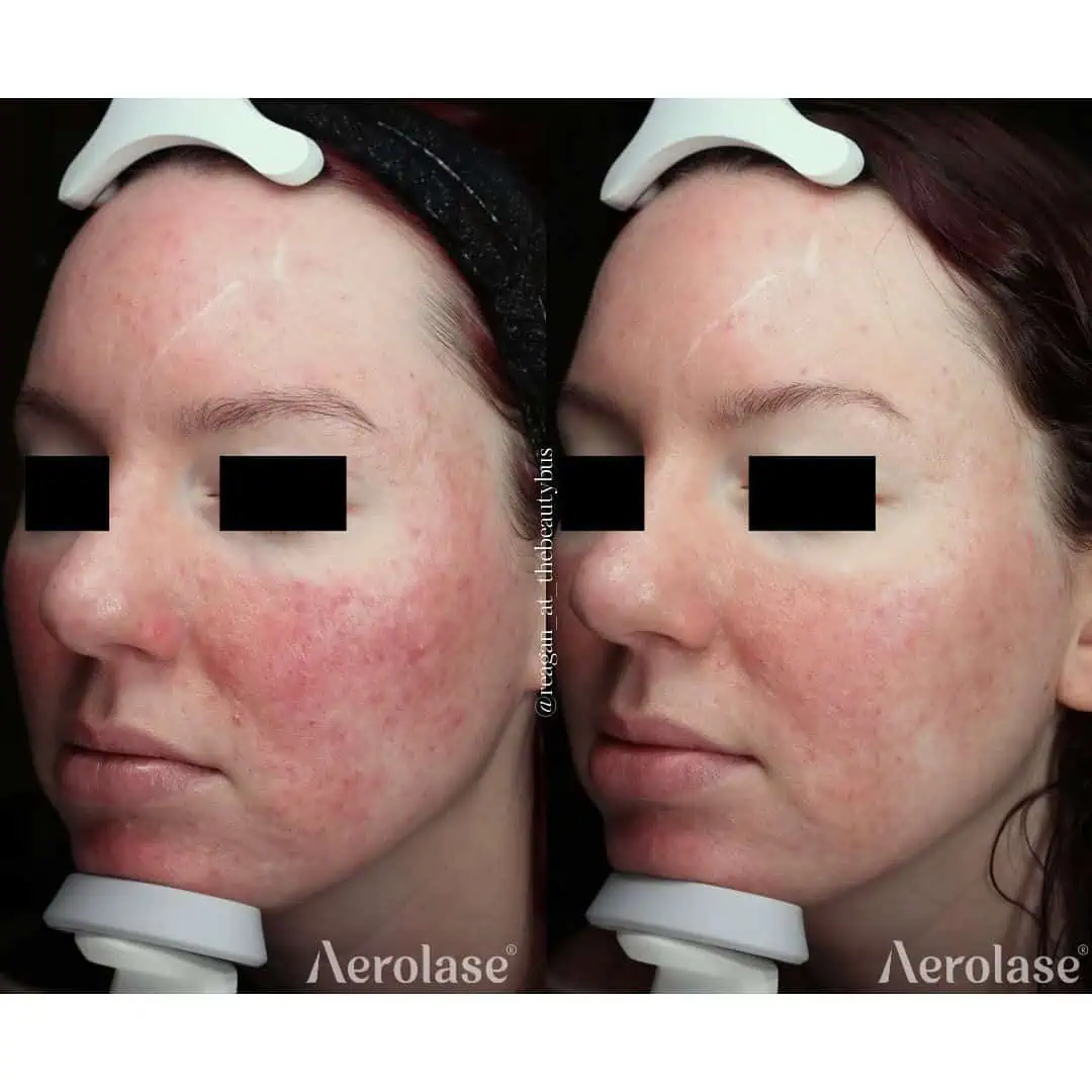 Rosacea - Photos courtesy of The Beauty Bus